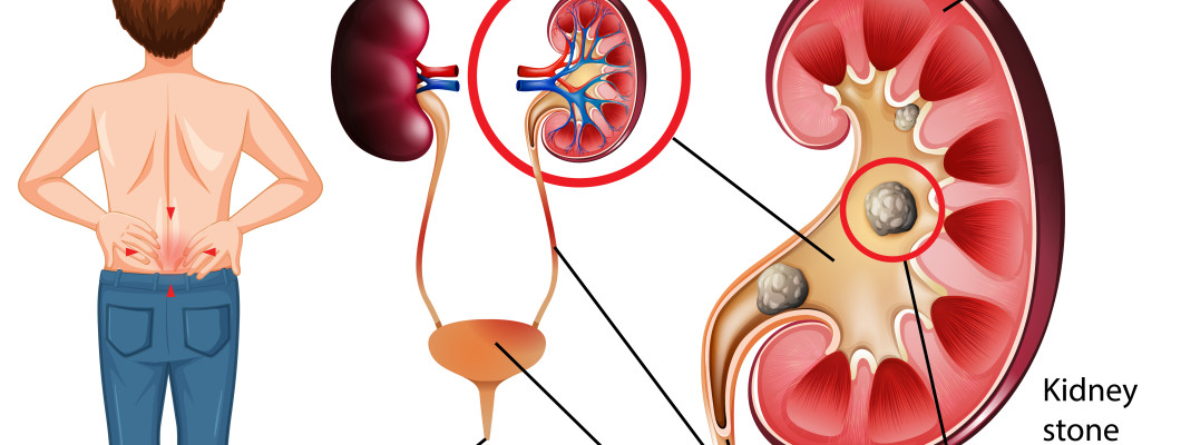 kidney stones