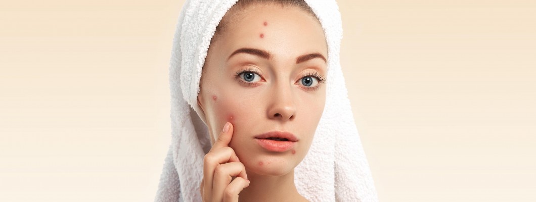 How to Remove Stubborn Pimples or Acne in Homeopathy
