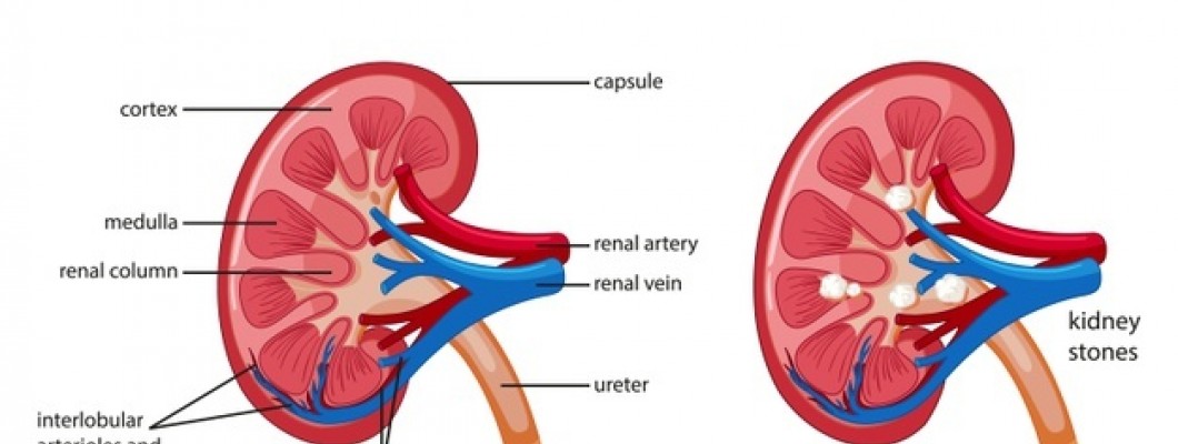 Homeopathy Medicines For Kidney Stones